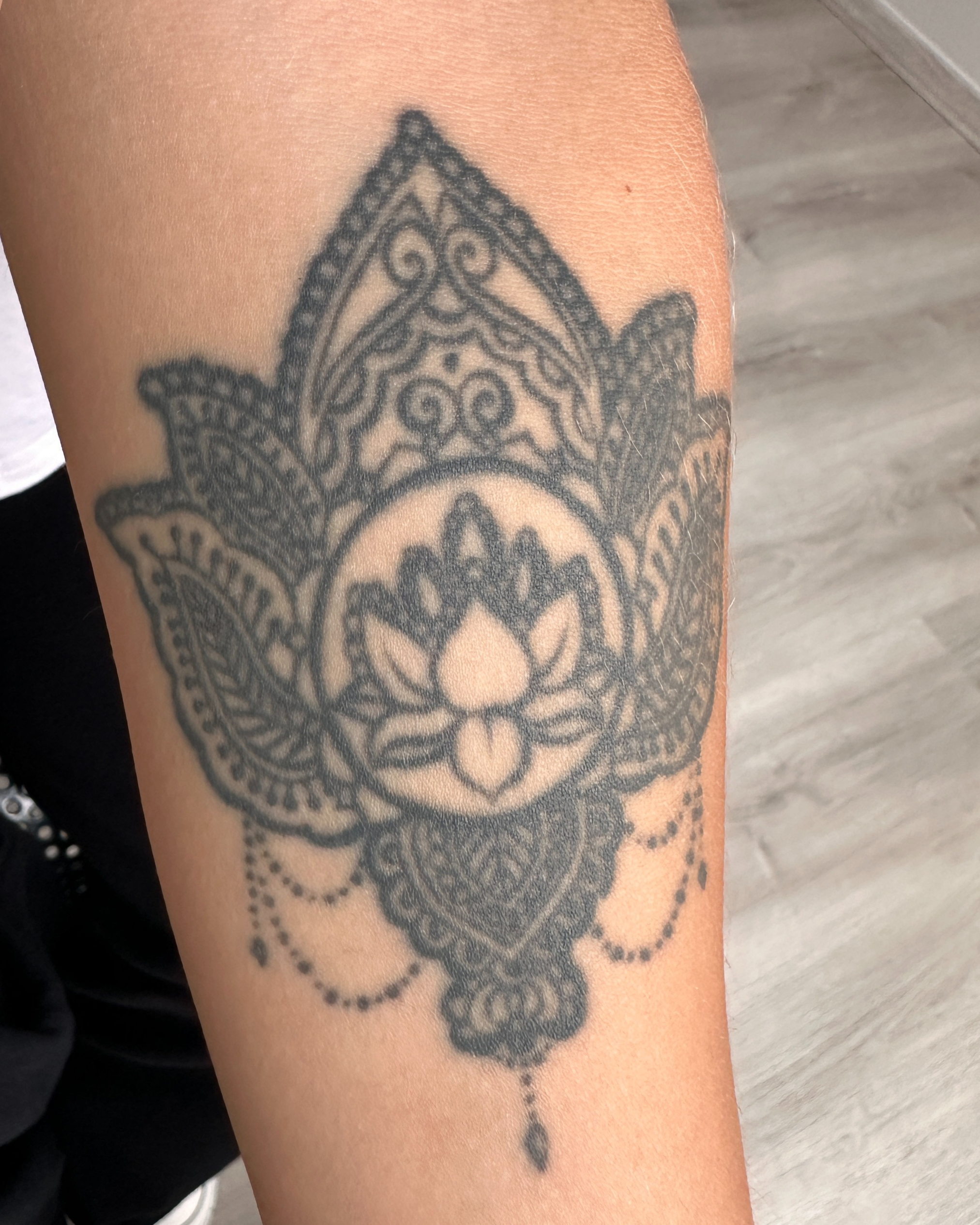 tattooentfernung
