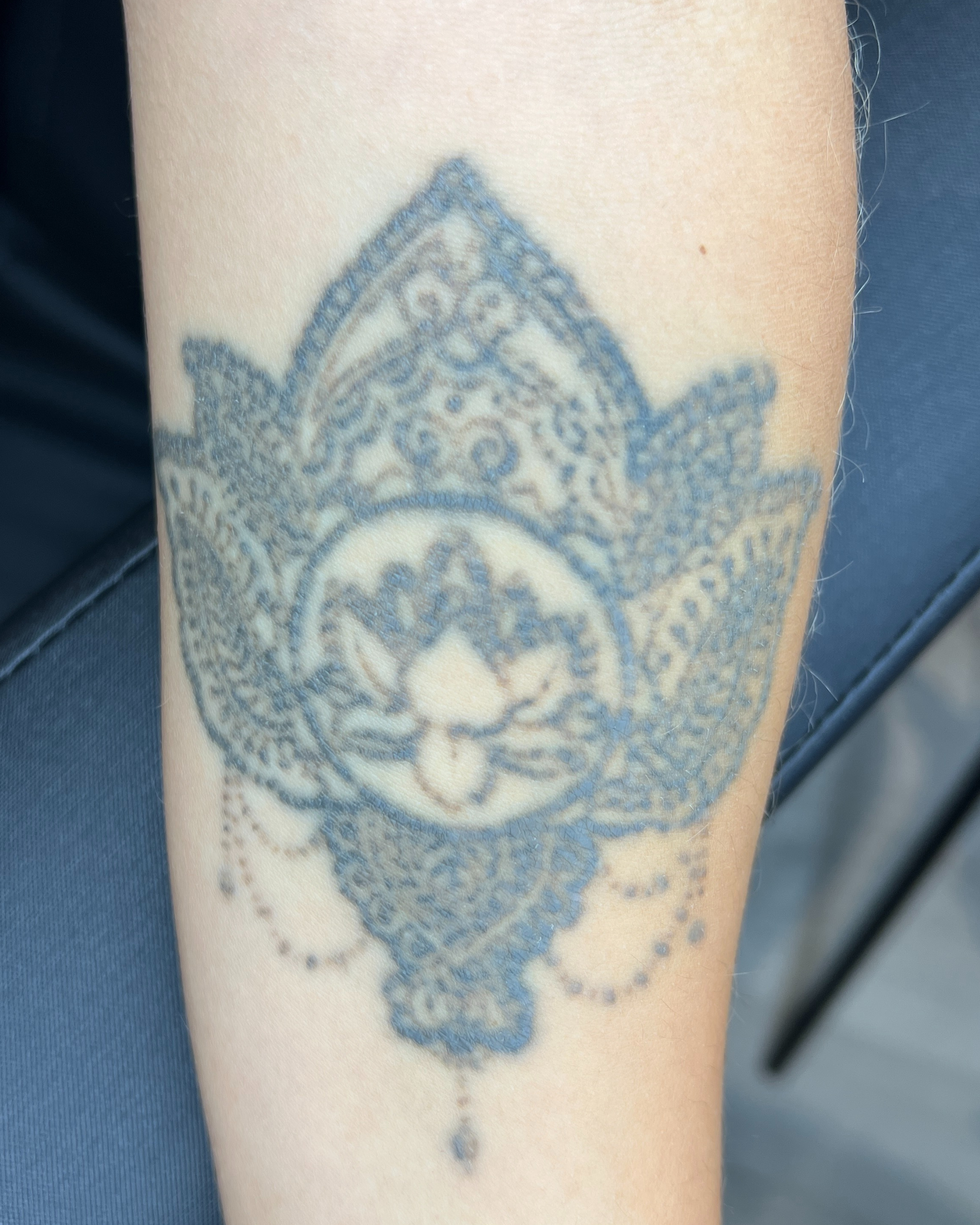 tattooentfernung
