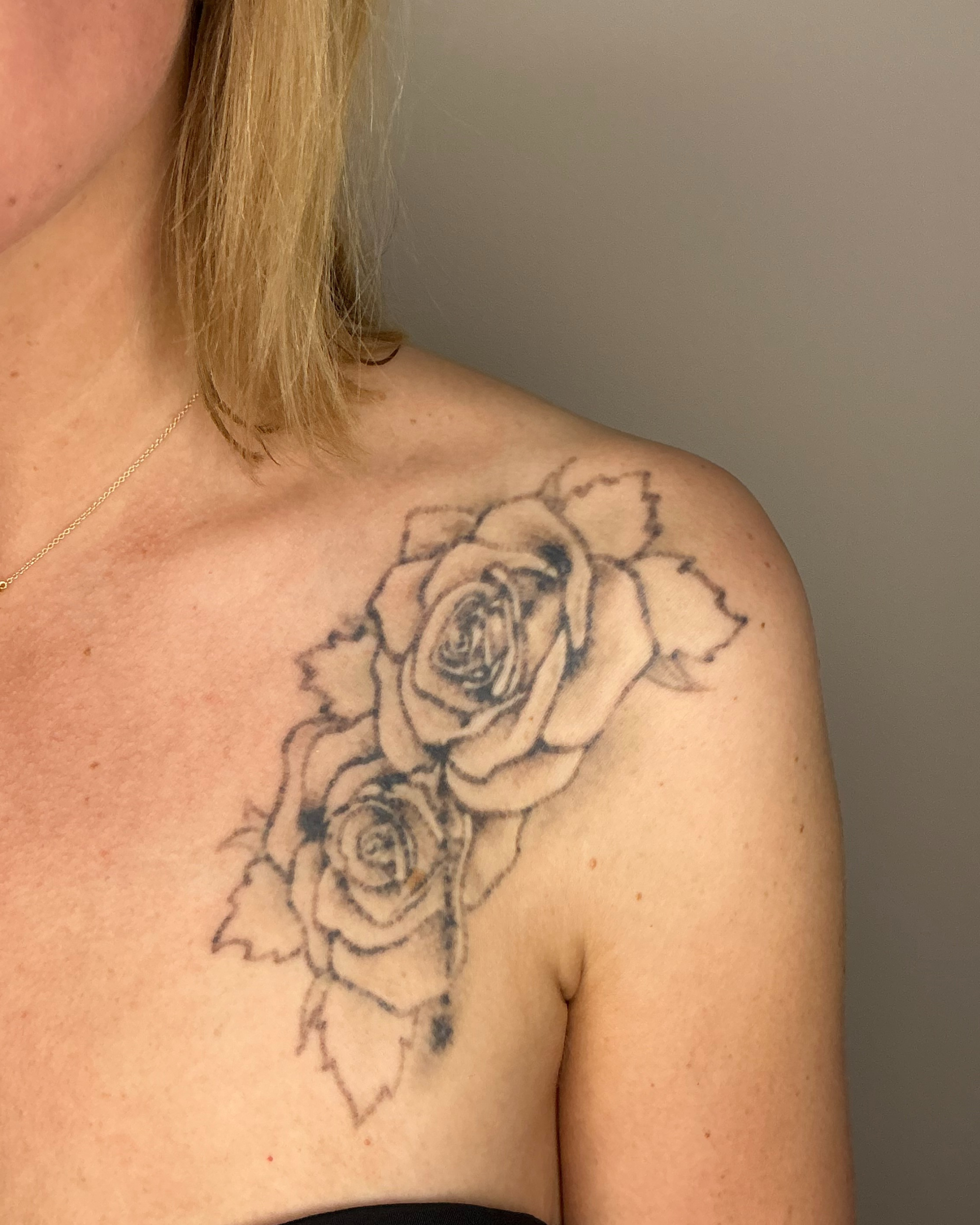 tattooentfernung