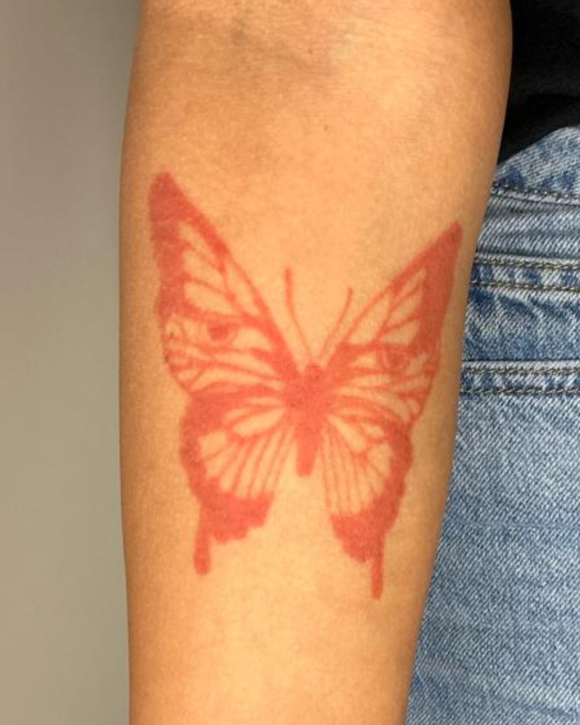 tattooentfernung