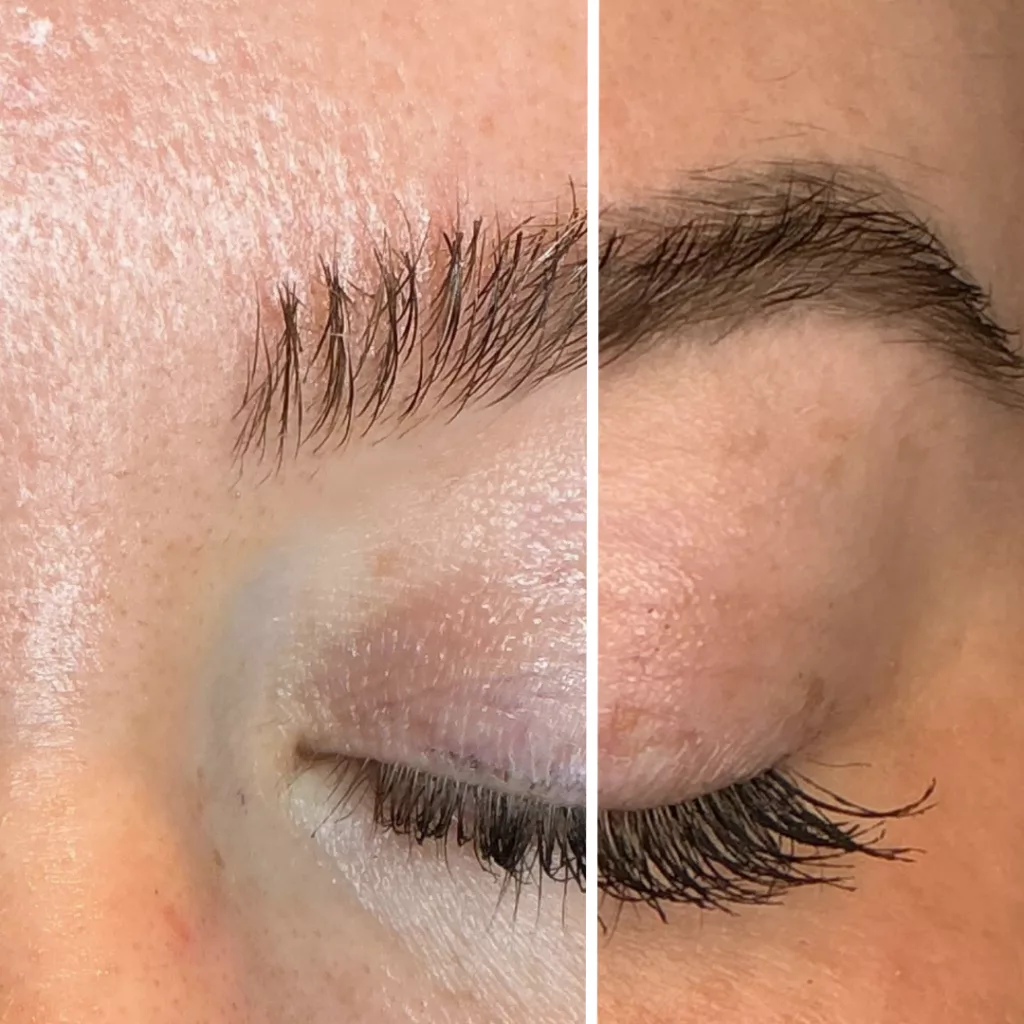 Entfernung von Permanent Make-Up an den Augenbrauen mit dem Picosekundenlaser