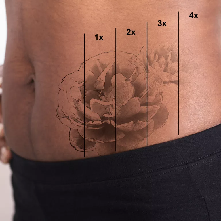 tatooremoval